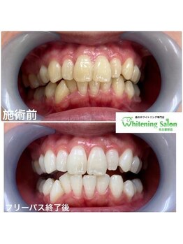 ホワイトニングサロン 名古屋駅店/【ホワイトニング施術例】