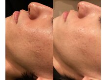 ブブオム 恵比寿本店(BUB OMME)/サーマトリックス