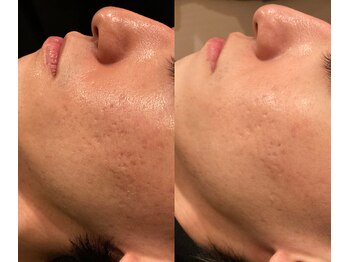 ブブオム 恵比寿本店(BUB OMME)/サーマトリックス