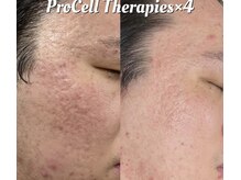 ルチル(Rutile)/プロセルセラピーズフェイシャル