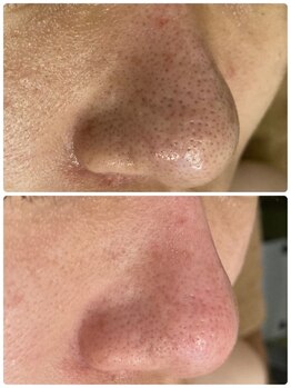 アリュール(ALLURE)/光ハイドロピーリングの施術効果