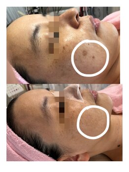 プリエール ビューティ/シミケア