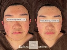 エル 麻布十番/たるみ/小顔/毛穴/フェイシャル