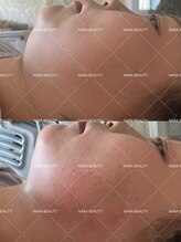 ナラビューティー(NARA BEAUTY)/韓国最新オンタリフト導入！