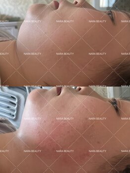 ナラビューティー(NARA BEAUTY)/韓国最新オンタリフト導入!