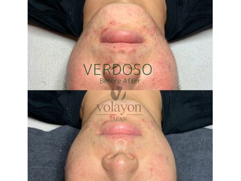 ナビ(NAVI)/ニキビケア、跡