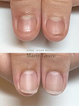 マリーロール 梅田店(Marie Laure)/自爪育成/深爪矯正/ネイルケア