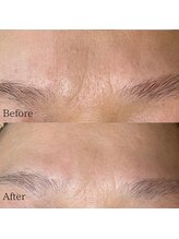 サロン ド エン(Salon de. en)/シワケア◇ハーブピーリング