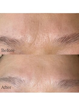 サロン ド エン(Salon de. en)/シワケア◇ハーブピーリング