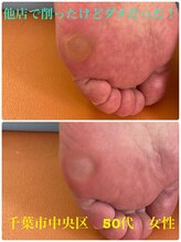 巻き爪じゅん 千葉駅前店/角質・ウオノメ・タコもお任せ！