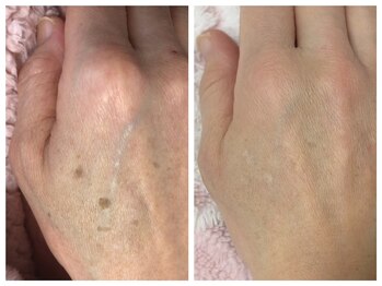 プリエール ビューティ/手の甲のシミケア