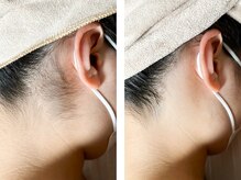 ウルオイ 海老名(URUoi)/脱毛Before→After