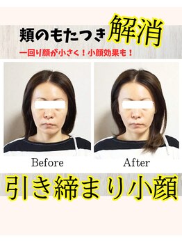 美容鍼＆首肩こり骨盤整体サロン ひふね/40代 美容鍼 Before/After