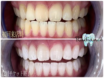 札幌セルフホワイトニング ラディアンス(Radiance)/プラチナム12回チケット