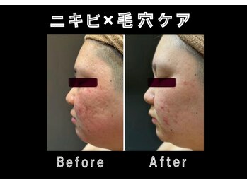 エステティック レイビス 銀座店(RAYVIS)/ホワイトスノーピール×ハーブ