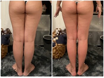 エンフィール(&.Feel)/下半身ライン1回変化