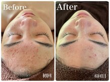 肌質改善サロン　Humming skin【3/2 NEW OPEN（予定）】/ハーブピーリング/ニキビケア