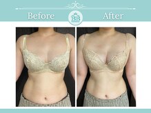 美人バスト 浦和店/【バストアップ★育乳】症例