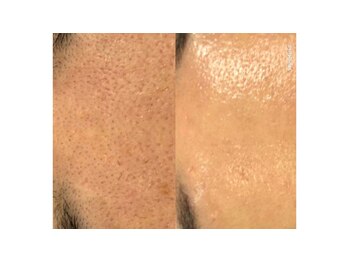 サロン ド ヒノキ(Salon de HINOKI)/毛穴ケア