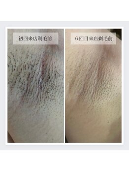 ボーテ ドゥ ランジュ(BEAUTE DE L’ANGE.)/◆女性わき脱毛◆