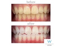 ホワイトニングショップ 会津若松店/Before&After美白ホワイトニング