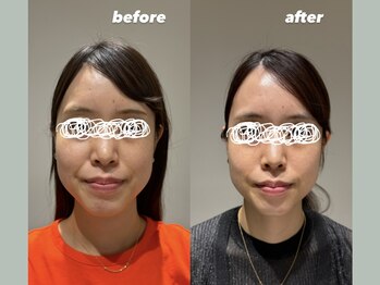 リタ 銀座(Rita)/ブライダルピーリング♪3回