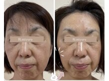 リミュール(Ri.miyuru)/小顔リンパマッサージ