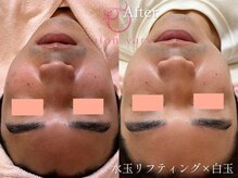 ヴェアリー 広尾(VARY)/赤みの鎮静、乾燥