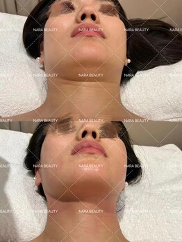 ナラビューティー(NARA BEAUTY)/韓国最新オンタリフト導入!