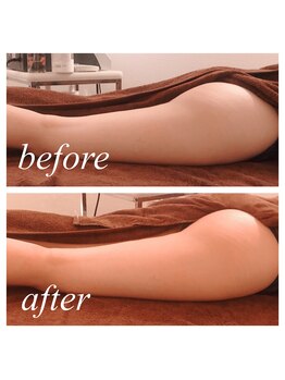 ボディーワークス 新町(BODY WORKS)/インディバでヒップアップ