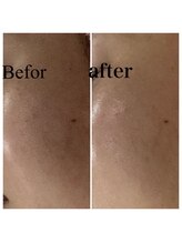 ペルボヌール 深井店/剥けないハーブピーリング1回