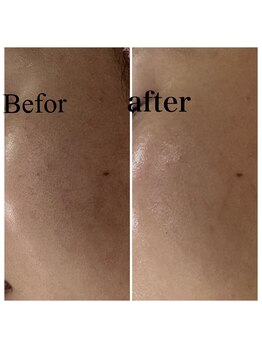 ペルボヌール 深井店/剥けないハーブピーリング1回