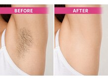 フォーグッド(forgood)/ワキ脱毛