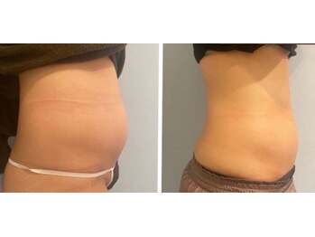 ルナグランデ(Luna grande.)/脂肪分解10ml 7回でこんなに!