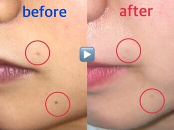 アイリープ(eyeleap)/☆シミケア集中!小顔筋膜リフト