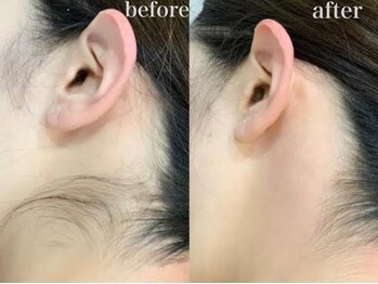 スリー(THREE)/都度払い脱毛【THREE】