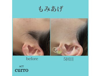 アクト クロ(ACT curro)/【もみあげ】脱毛施術例