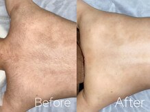 バーニー 梅田店(BARNEY)/脱毛