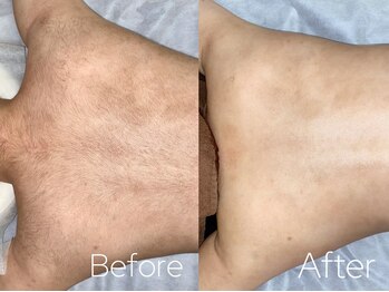 バーニー 梅田店(BARNEY)/脱毛