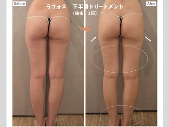 エントテ(en to Te)/下半身痩身♪冷え・ムクミ改善