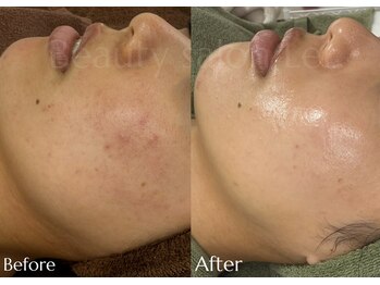 レイ(Lei)/ニキビ/毛穴/ハーブピーリング