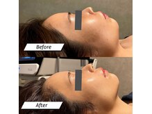 話題の無針水光注入ミコステラ取扱でうるツヤ肌管理♪