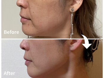 サロンドモモ(SALON de MOMO)/ホワイトスノーピール×WINBACK