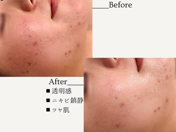 エミィ(emmy)/【肌質改善】本気のニキビケア