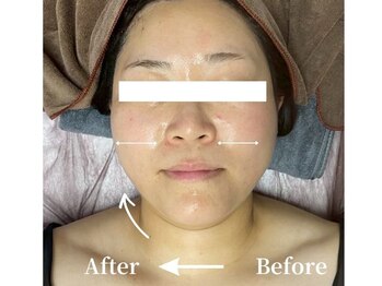 ミスティア(mistia)/エステ【顔】1回/半顔10分