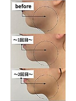 ベル(BELL)の写真/SNSで話題の韓国美容【小顔オンダウェーブ｜8,980円★】"結果重視"の超最新施術でたった一度でも効果実感◎