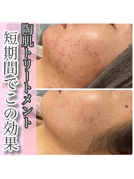 マリアム(mariam)/歯髄幹細胞CYSAYでの肌変化