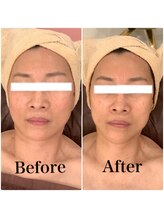 スペチアーレ 夙川/たるみ改善引き上がり抜群♪