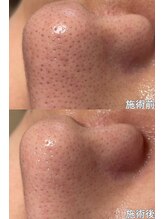 クレアナ ザ ビューティー(KULEANA the beauty)/毛穴クレンジング+光フォト