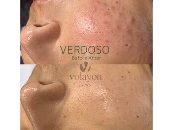 ナビ(NAVI)/ニキビケア、跡